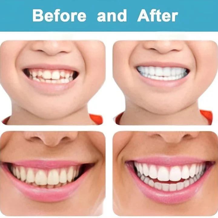 Snap on Smile 2Pcs/Set Comfort Fit White Teeth Cover Veneer Kit